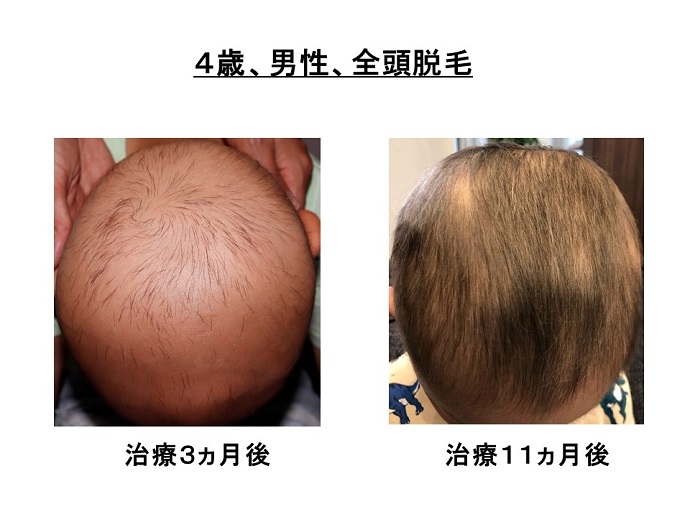円形脱毛症　病院